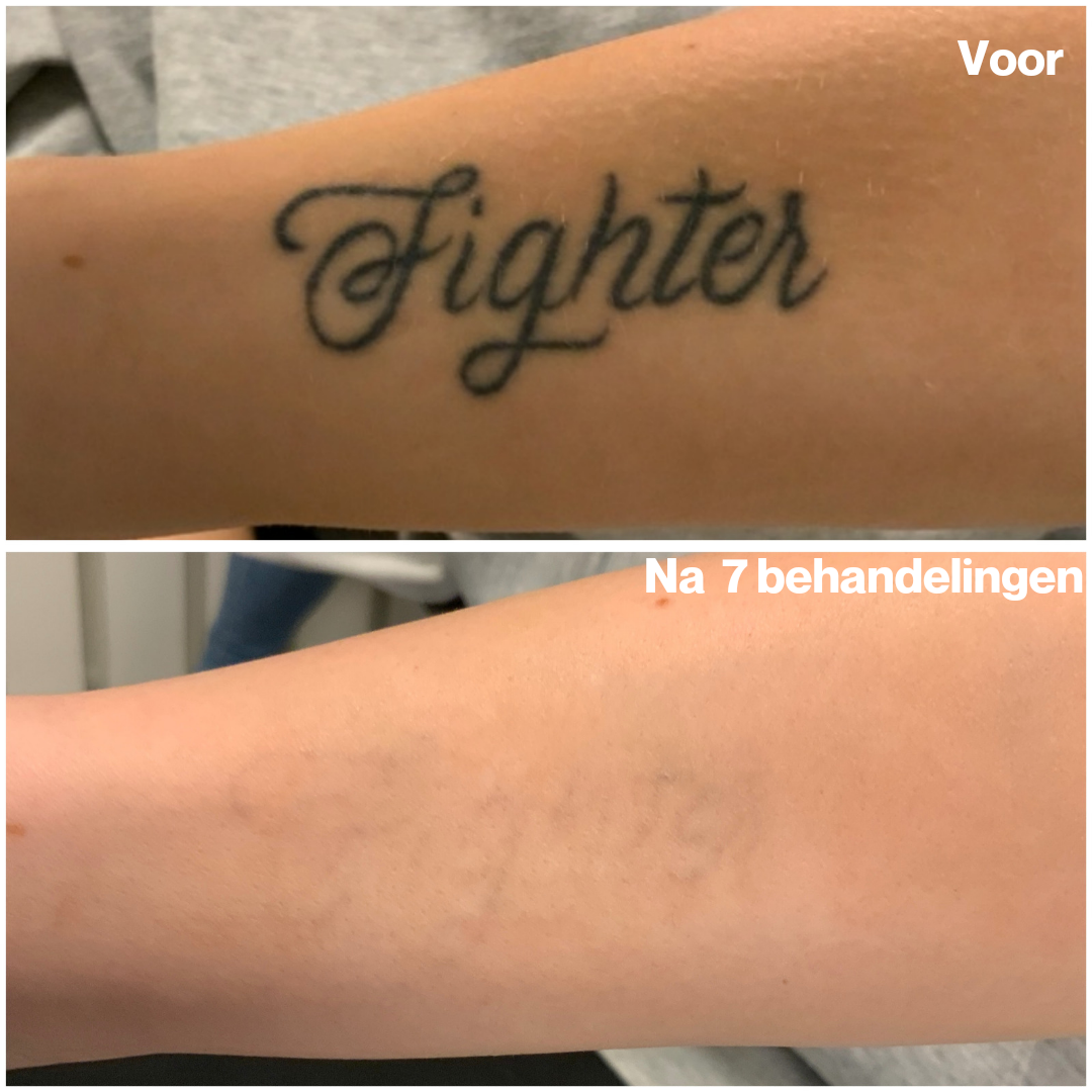 Tattoo weglaseren: Voor en Na