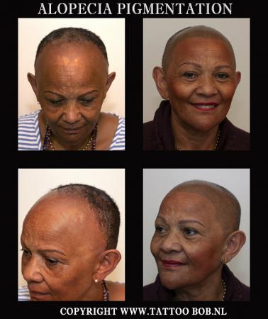 microhaarpigmentatie bij alopecia 