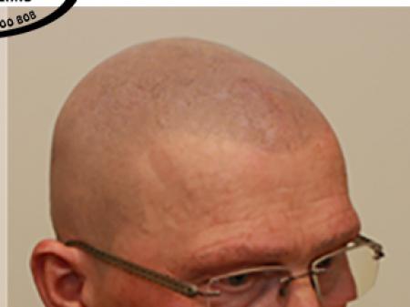 Micro haar pigmentatie is een goede oplossing voor mensen met Alopecia.