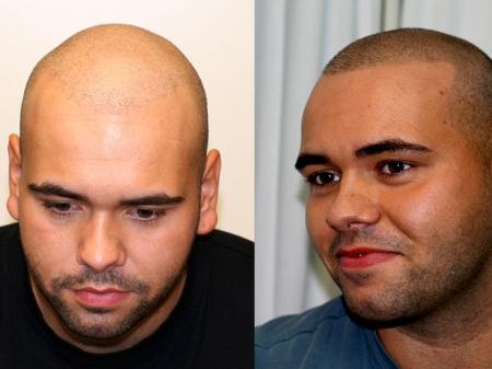 Op de linkerfoto heeft de jongen een haartransplantatie laten doen met voor hem tegenvallend resultaat.
Rechts hebben wij stoppels getatoeëerd.