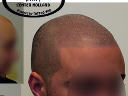 Deze jongen heeft reeds al meerdere haartransplantaties ondergaan met verschrikkelijke gevolgen. Littekens op het achterhoofd en donorhaar wat niet genoeg doorkwam. Met Micro Haar Pigmentatie hebben wij het probleem kunnen verhelpen. In combinatie met de