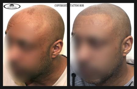 Darkskin scalp pigmentation.jpg