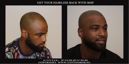 mhp hairline 3-8-2019.jpg