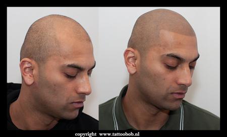 micro-hair-pigmentation-5-4.jpg