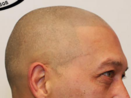 Micro Haar Pigmentatie is in de Verenigde Staten, ook wel bekend als Scalp Micropigmentation (SMP) of Scalp Pigmentation. In Nederland zult u veel het woord of de term "Stoppeltattoo"  horen . Tattoo Bob heeft dit begrip als eerste MHP-specialist in Neder