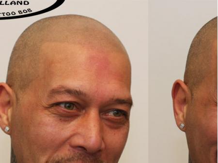 Voor en na foto's van een micro haar pigmentatie. Tattoo BOB Rotterdam!