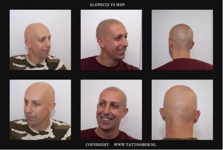 ALOPECIA VS MHP 10 -9.jpg