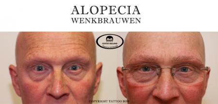 Haaruitval ten gevolge van Alopecia kan op ieder plek voorkomen.