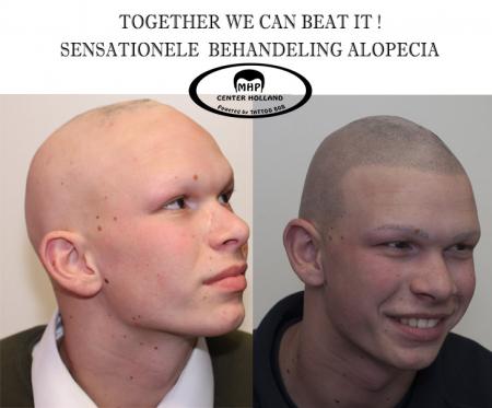 De oplossing haar pigmentatie ofwel micro hair pigmentatioe (MHP)Alopecia Areata is 1 van de bekendste vormen van Alopecia. Alopecia Areata begint vaak met grote of kale plekken op het hoofd. Deze kale plekken zijn vaak rond of ovaal van vorm.