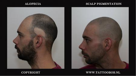 alopecia 27-3-2019.jpg