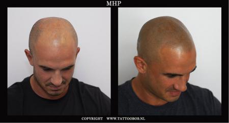 alopecia 8-9.jpg