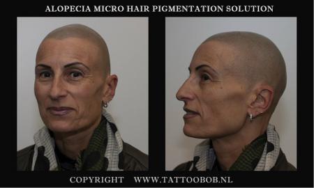 alopecia tattoo 2018.jpg