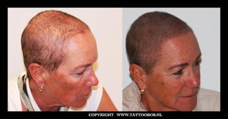 alopecia-6-4-vrouwen.jpg