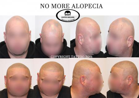 Door middel van het tatoe_???ren van stoppeltjes op de hoofdhuid, is er niets meer te zien van de ziekte alopecia.