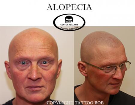 Micro haar pigmentatie is een goede oplossing voor mensen met Alopecia.