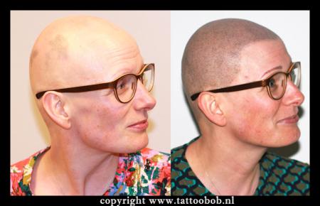 alopecia-bij-vrouwen-9-9-2023.jpg