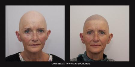 alopecia-tattoo-14-11.jpg