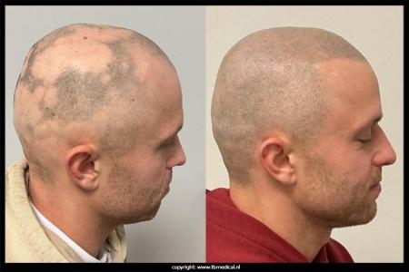 mhp-alopecia-29-11-25-1.jpg