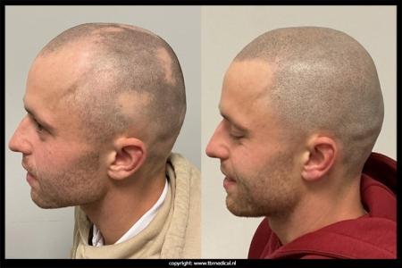 mhp-alopecia-29-11-25-3.jpg