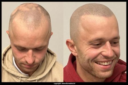 mhp-alopecia-29-11-25-4.jpg