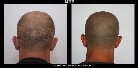 mhp-alopecia-ralph.JPG
