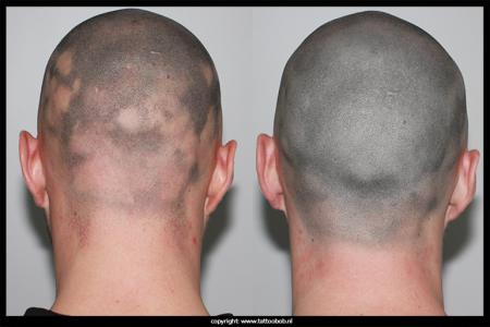 opvullen-met-mhp-bij-alopecia.jpg