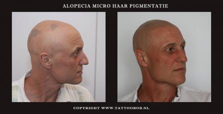 Microhaar pigmentatie de oplossing voor Alopecia