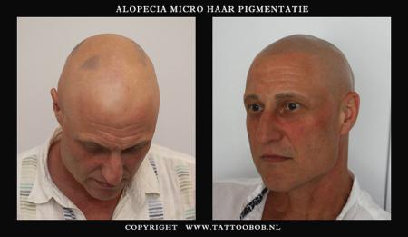 Haaruitval door alopecia