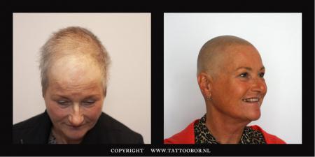 dames haaruitval stress alopecia ziekte