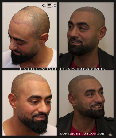 arabicstoppel micro hair pigmentation.jpg