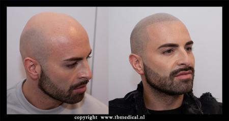 scalp-pigmentation-micro-hair-pigmentation.jpg