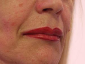 De lippen kunnen kort na de behandeling iets gezwollen zijn.