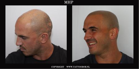 alopecia mhp 2.jpg