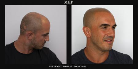 alopecia mhp 8-9.jpg