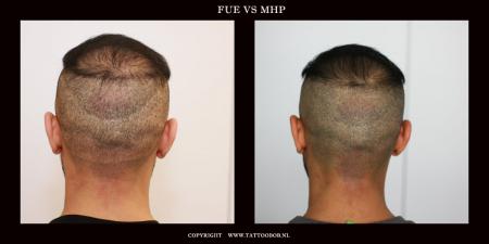 fue hair transplant.jpg