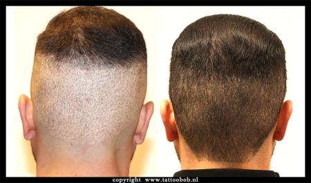 haartransplantatie-fue-16-3.jpg