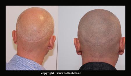 haartransplantatie-micro-haar--pigmentatie-15-10.jpg