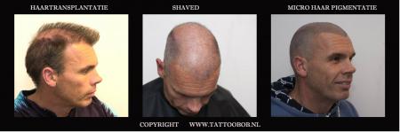 haartransplantie vs tattoo 2-12.jpg