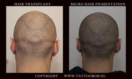 hairtransplantation 2019.jpg