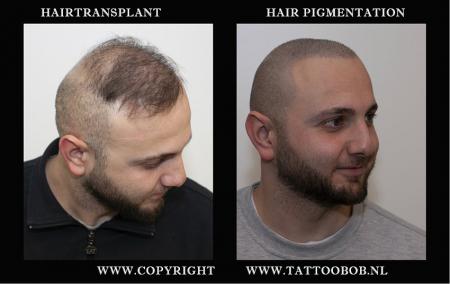 scalppigmentation vs hairtranplant 23-2.jpg