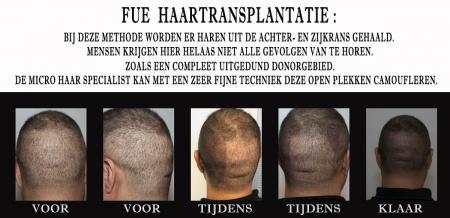 Mensen kiezen vaak de Fue haartransplantatie techniek....echter zijn ze niet op de hoogte van de enorme littekens.
Met Micro haar pigmentatie kan je het weliswaar herstellen