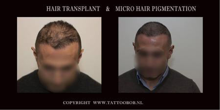 Een haartransplantatie is niet altijd genoeg om de kaalheid te verbergen.....daarom kies men vaak voor micro haar pigmentatie  om het op te vullen.