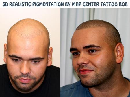 Op de linkerfoto heeft de jongen een haartransplantatie laten doen met voor hem tegenvallend resultaat.