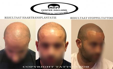 Resultaat van een haartransplantatie is ook niet altijd naar tevredenheid van de pati_???nt. Met Micro haar pigmentatie ofwel stoppel tattoo kan wel 100% dichtheid bereikt worden
