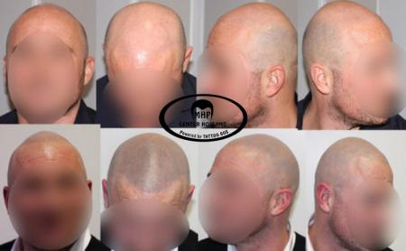 Voor en na foto's van de behandeling micro haar pigmentatie.