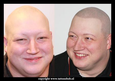 alopecia-29-2.jpg