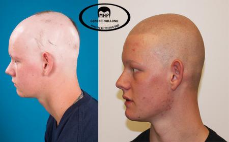 Deze jongen afgebeeld op de foto's heeft van jongs af aan Alopecia.