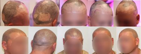 WAT IS ALOPECIA AREATA?