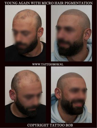 contour scalp pigmentation Holland 1.jpg