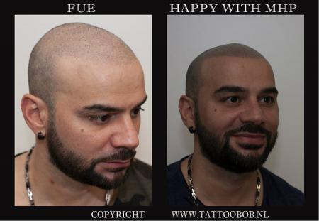 fue haar transplantatie of stoppeltattoo 10-7.jpg